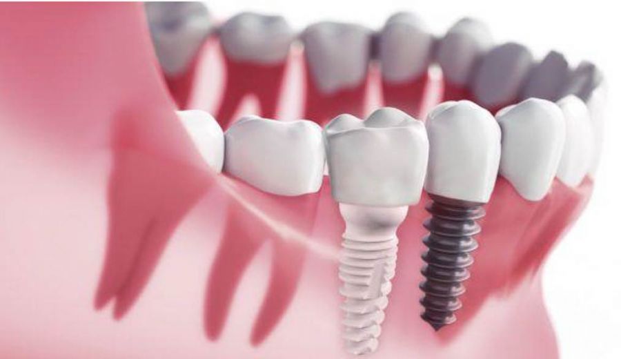 Clínica Dental en Madrid 14 Implantes Circonio Madrid: Guía Completa 2026 – Precio, Ventajas y Comparativa
